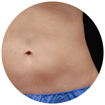 fat-freezing-treatment-area