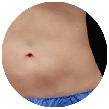 fat-freezing-treatment-area